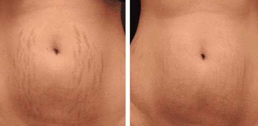 Stretch Marks & Scarring  Elegance Medical Aesthetics – Botox, Cosmetic  and Laser Clinic